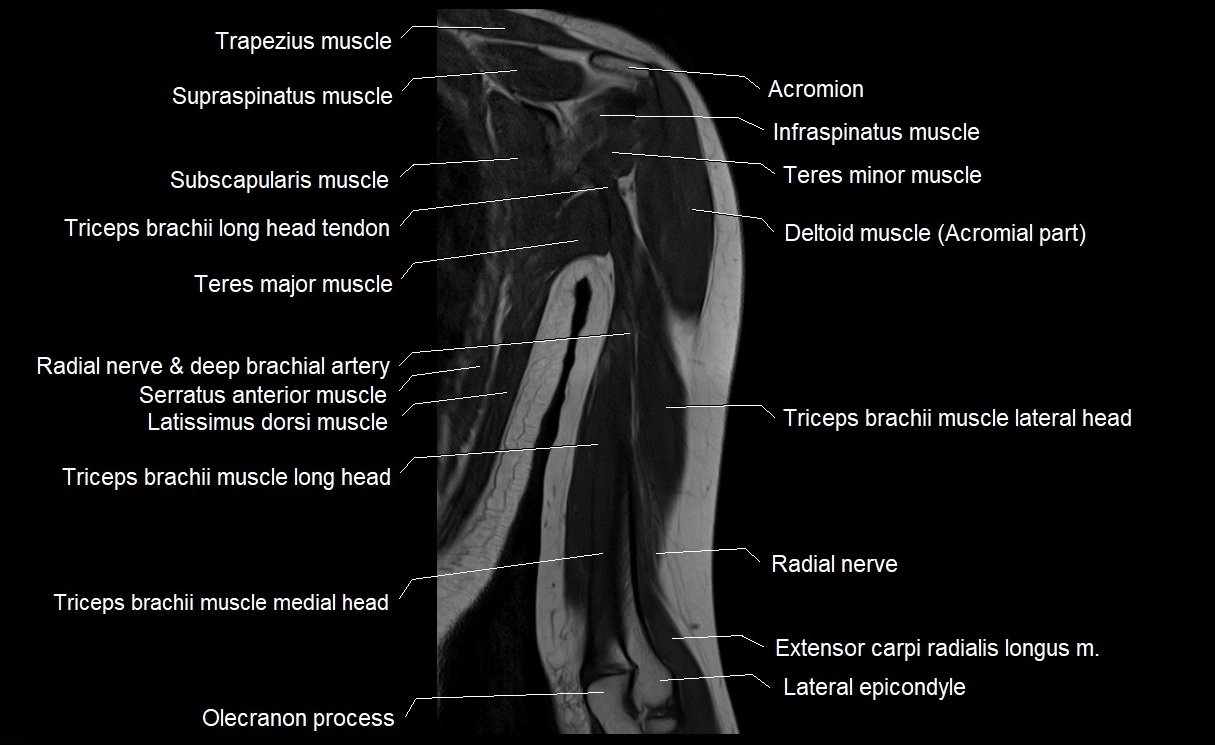 MRI upper arm (humerus ) coronal cross sectional anatomy image 19.webp